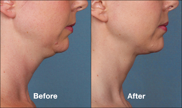 Kybella Chin Sculpting Before and After photo