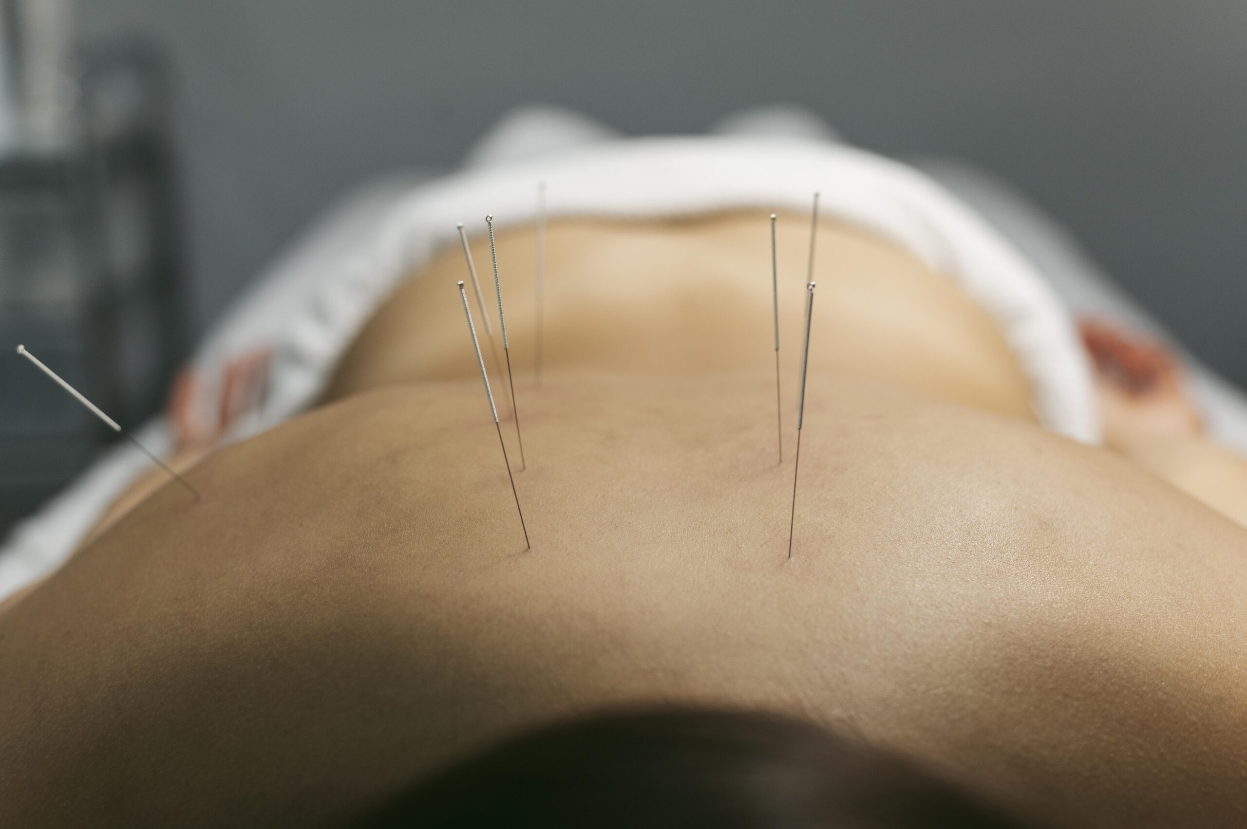 Acupuncture session in Tamarac FL Image provided by Freepik